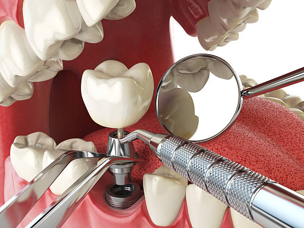 Best Emergency Tooth Extraction  in Bloomington, IL